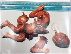 aborted-baby-found-1987.jpg