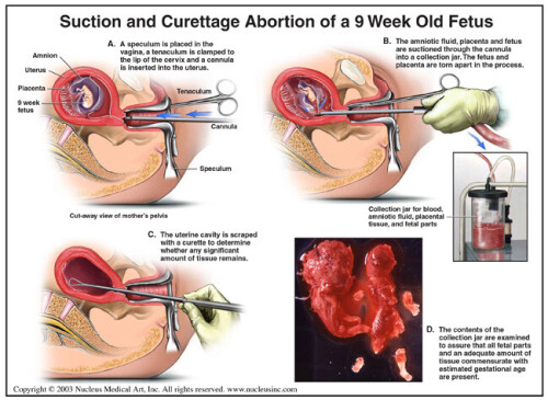 abortionmethods.jpg